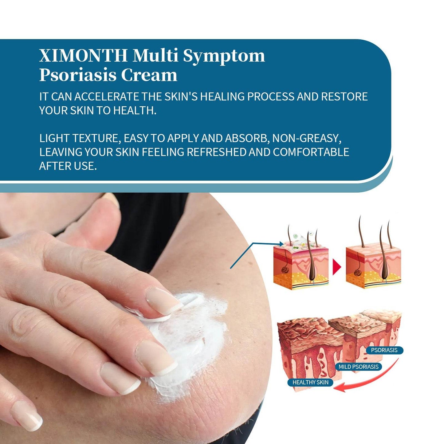 Ximonth Psoriasis Treatment Cream for Redness and Itch Relief - Estalios