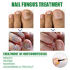 Nail Repair Solution Tea Tree Oil Essence Gentle Nourishing Manicure Cleansing Soft Nail Care Solution