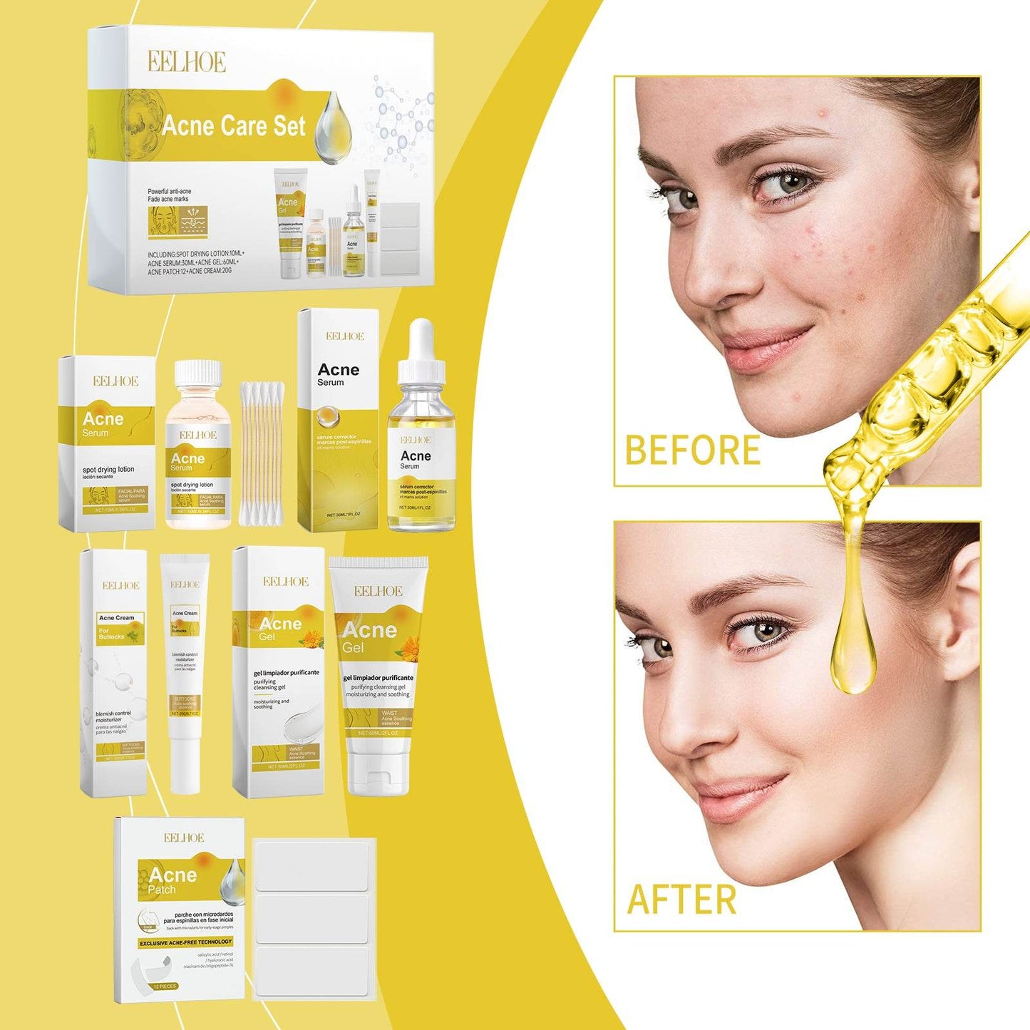 Acne Skin Care Set for Moisturizing and Soft Skin - Estalios