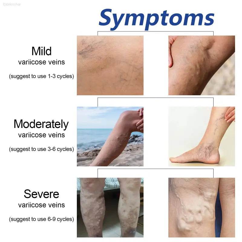 Heating Leg Cover for Blood Circulation and Lymphatic Relief - Estalios
