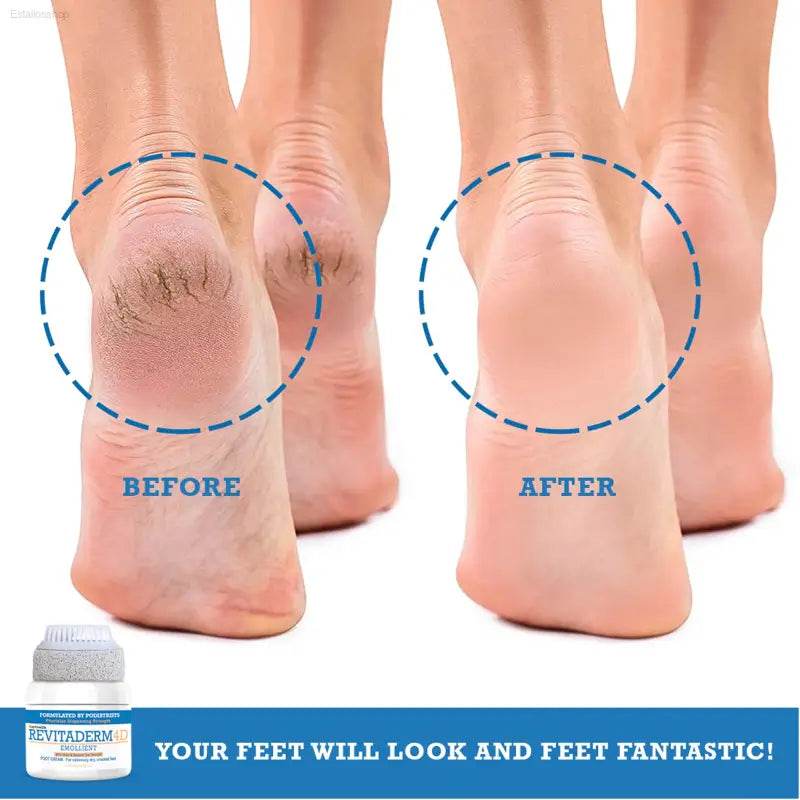 Activelife Revitaderm 4D Urea Foot Cream - Intensive Moisturizer for Dry, Cracked Skin on Feet, Hands, Elbows & Knees, Plus Free Pumice Stone - 4Oz Ultra Repair Formula with Callus Remover - Estalios