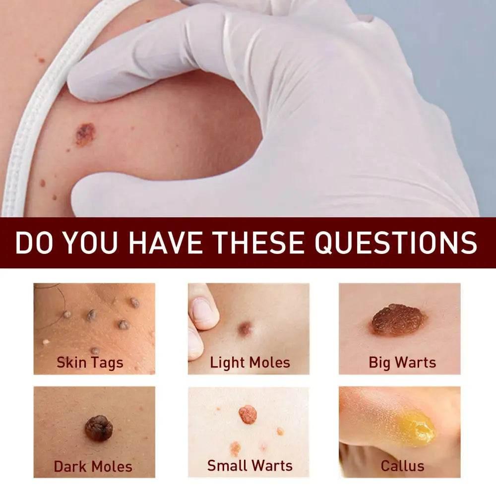 Jaysuing Wart Cream Pen for Fast Skin Repair - Estalios