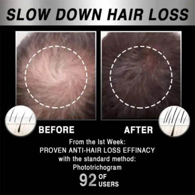 Amp Up Your Hair Game with Innovative Laser Growth Cap - Estalios