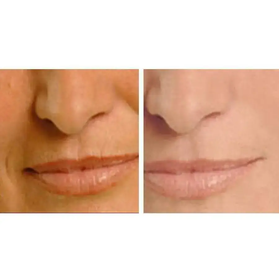 Before and after lip enhancement with LeVea Night Repair Anti-Aging Treatment