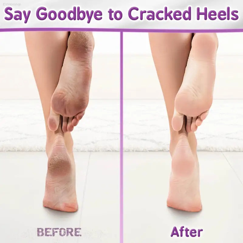 Next Gen U Cracked Hands & Heel Repair Cream - 8.5oz Ultra Moisturizing Formula for Extremely Dry and Sore Skin - Estalios