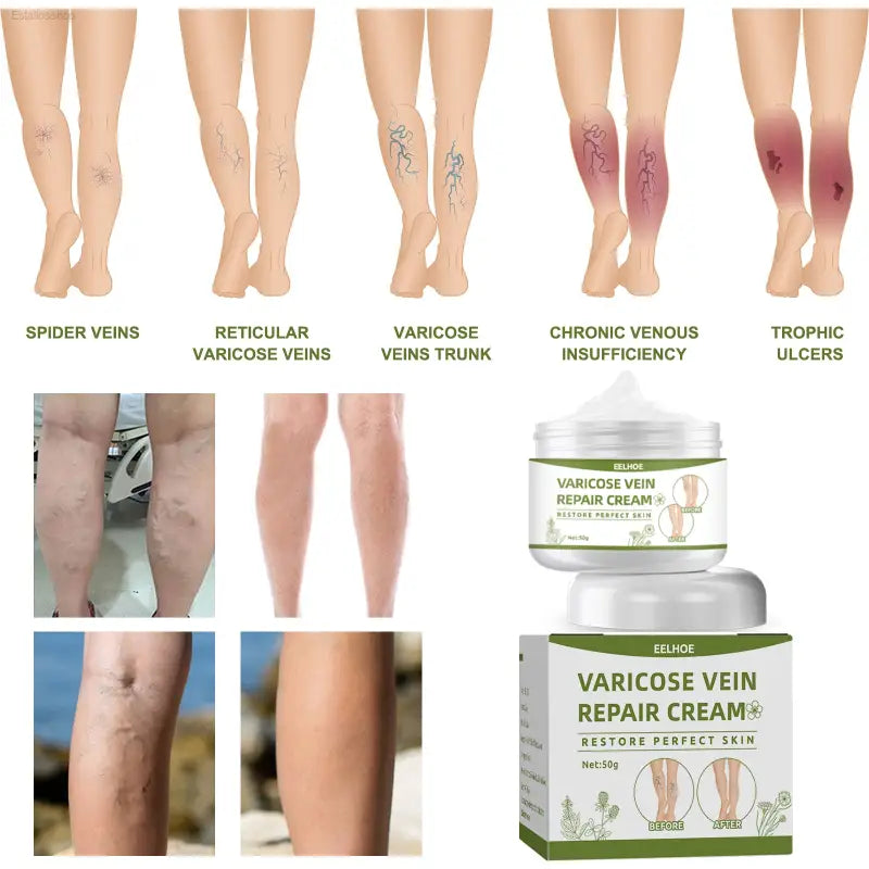 🌿 Soothing Relief – Leg Repair Cream for Varicose Veins | Nourish and Revitalize Tired Legs - default title