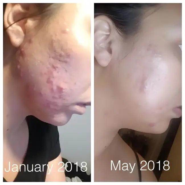 Super Acne Fighter Duo for Fast Cystic Acne Relief - Estalios