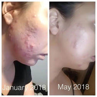 Super Acne Fighter Duo for Fast Cystic Acne Relief - Estalios