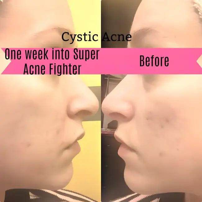 Super Acne Fighter Duo for Fast Cystic Acne Relief - Estalios
