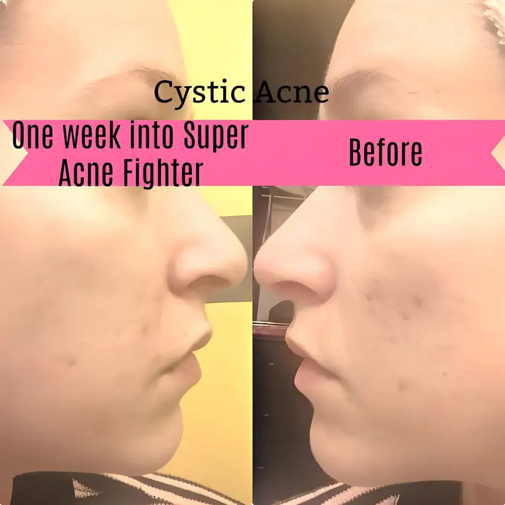 Cystic acne treatment comparison with Super Acne Fighter Seed Oil for an organic acne treatment