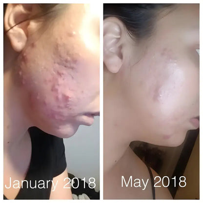 Before and after results of Super Acne Fighter Seed Oil organic acne treatment