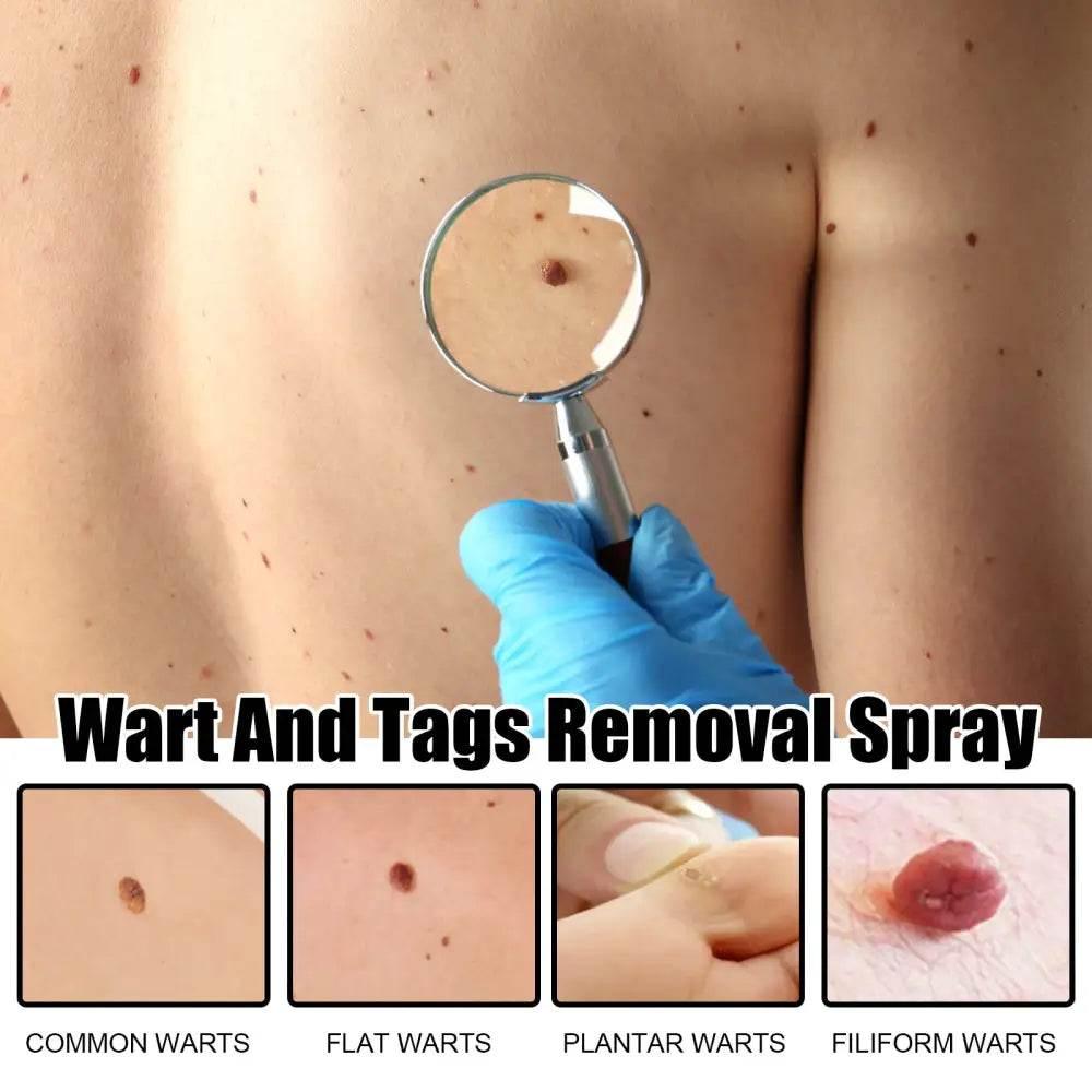 Ximonth Wart And Tags Removal Spray for Smooth Skin - Estalios
