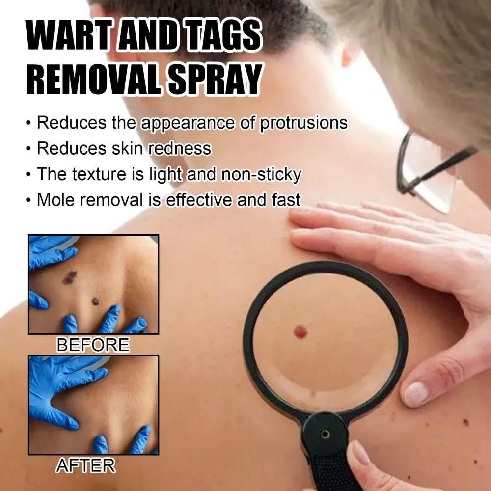 Ximonth Wart And Tags Removal Spray for Smooth Skin - Estalios
