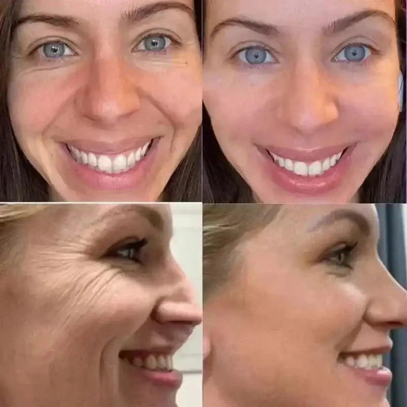 Youthful Glue-Free Lift Patches – Say Goodbye to Fine Lines! Wind Beauty Store  EstaliosShop